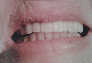 Implante CASO1